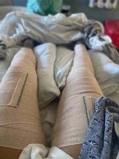 Rainbow in recovery, legs bandaged from burns